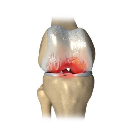 knee_arthritis