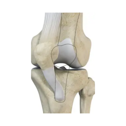 patella_dislocation