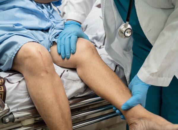 Asian senior or elderly old lady woman patient show her scars surgical total knee joint replacement Suture wound surgery arthroplasty on bed in nursing hospital ward, healthy strong medical concept. Asian senior or elderly old lady woman patient show her scars surgical total knee joint replacement Suture wound surgery arthroplasty on bed in nursing hospital ward, healthy strong medical concept.
